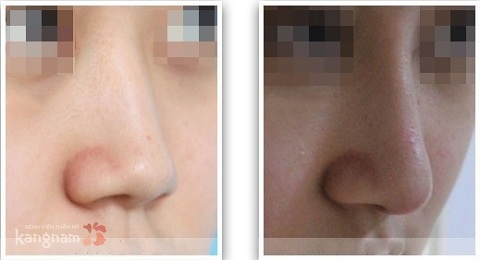 Nâng mũi không phẫu thuật có hại không-3