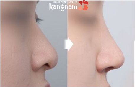 Nâng mũi không phẫu thuật có hại không-4