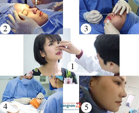Quy trình phẫu thuật nâng mũi tại Kangnam