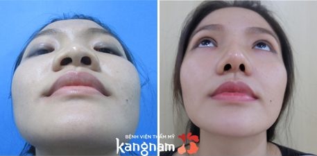Kết quả thu gọn đầu mũi tại Kangnam