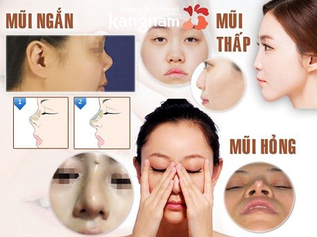 nâng mũi có ảnh hưởng đến khứu giác không-4