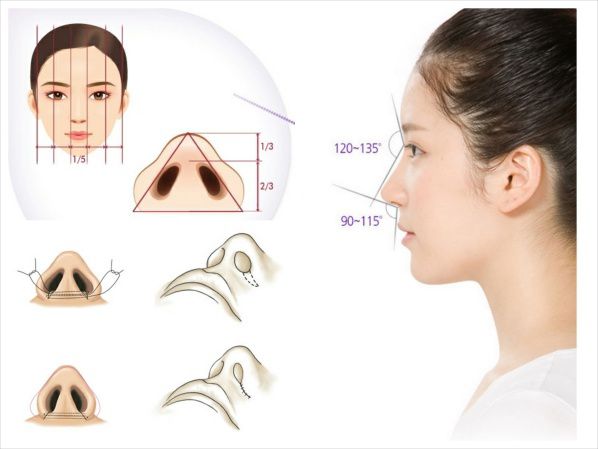 Mô hình giải đáp phẫu thuật cắt cánh mũi được thực hiện thế nào?