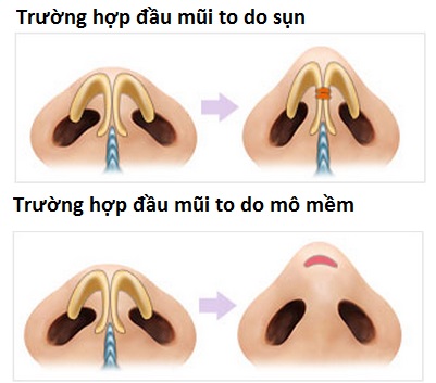 Phau thuat thu nho dau mui het bao nhieu tien tai Kangnam