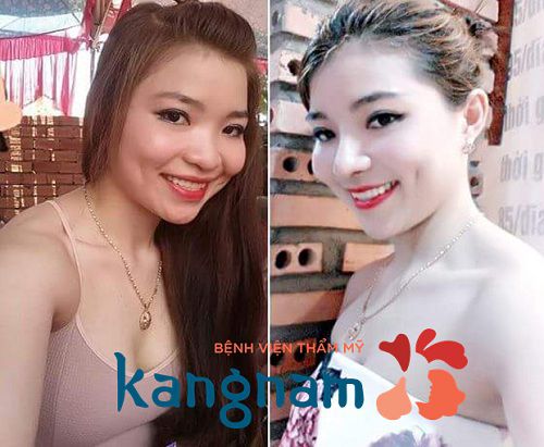 Thu nhỏ đầu mũi bao nhiêu tiền tại BVTM Kangnam?
