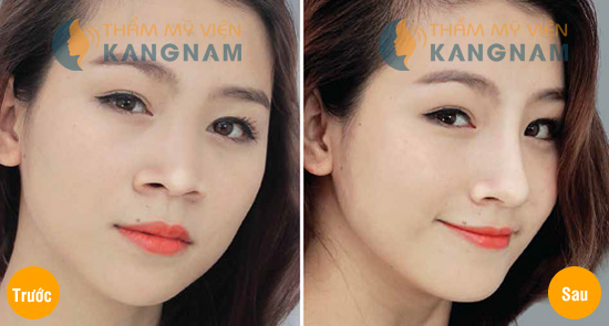 nâng mũi có được vĩnh viễn không