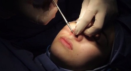 Chuyên gia giải đáp nâng mũi bọc sụn là gì?