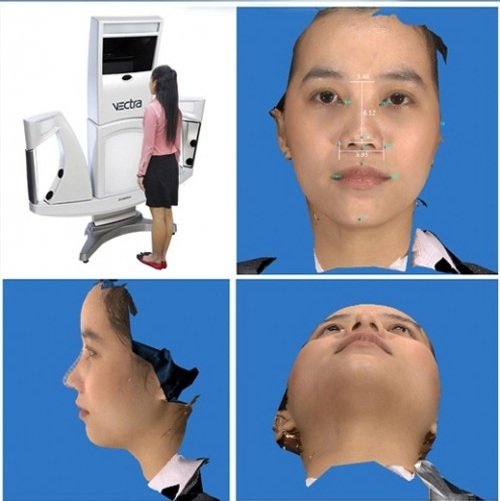 Mô hình phẫu thuật nâng mũi s line 3D tại Kangnam