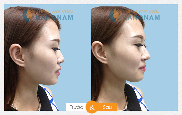 nang-mui-co-dau-khong2