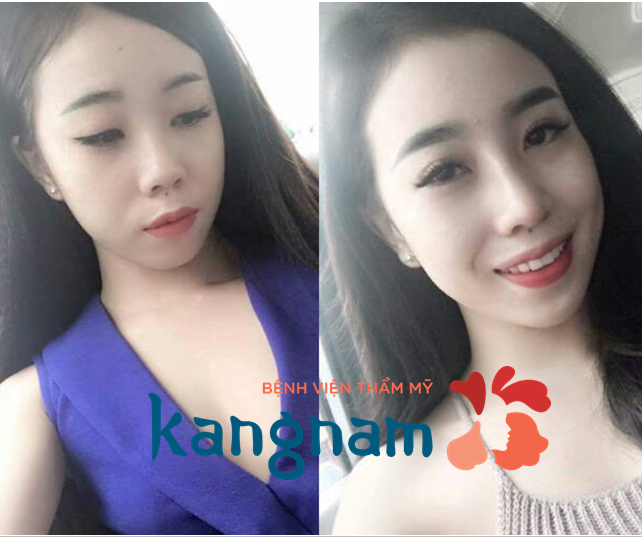 Kết quả hình ảnh cho site:nangmuidep.vn nâng mũi l line