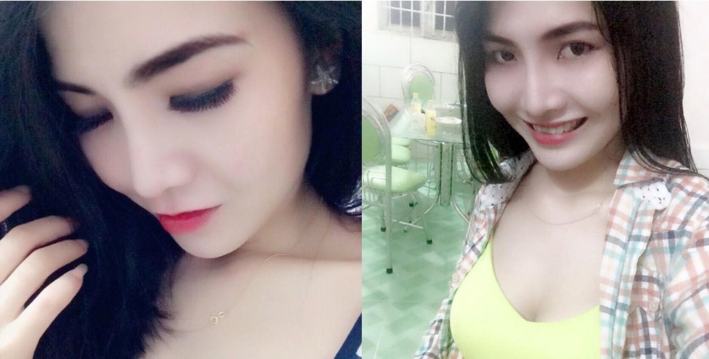 Nâng mũi có được lâu dài không? 3