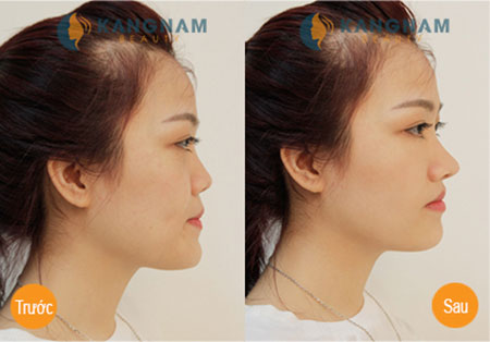 Có nên nâng mũi s line? Lời khuyên từ chuyên gia 2