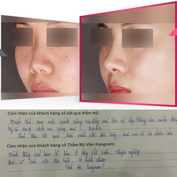 Có nên nâng mũi không phẫu thuật? - Chuyên gia nói gì? 2