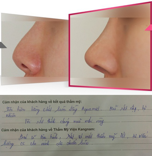 Có nên nâng mũi không phẫu thuật? - Chuyên gia nói gì? 3