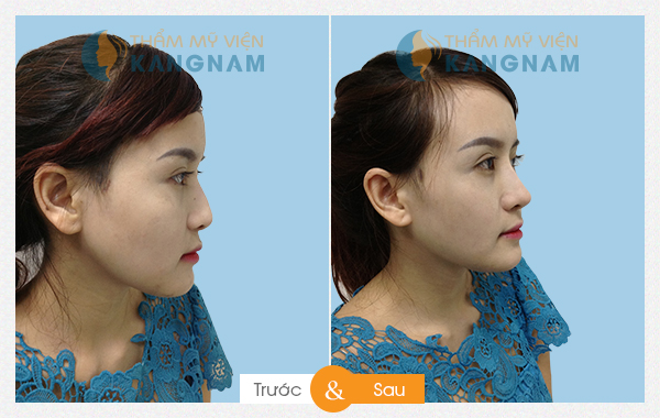 Trước và sau khi nâng mũi tại thẩm mỹ viện kangnam