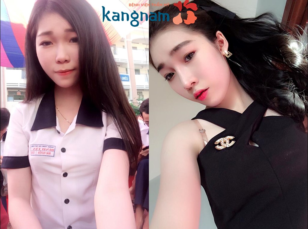 Trước và sau khi nâng mũi tại thẩm mỹ viện kangnam