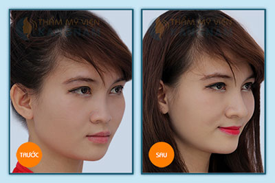 Nâng mũi tại thẩm mỹ viện KANGNAM có tốt không? 5