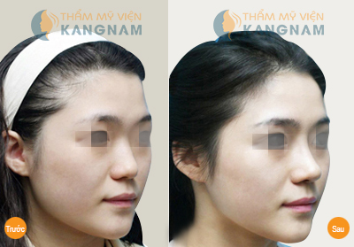 Nâng mũi bọc sụn an toàn tại Thẩm mỹ viện Kangnam