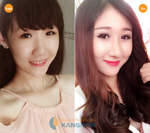 Phẫu thuật nâng mũi mất bao lâu? 3