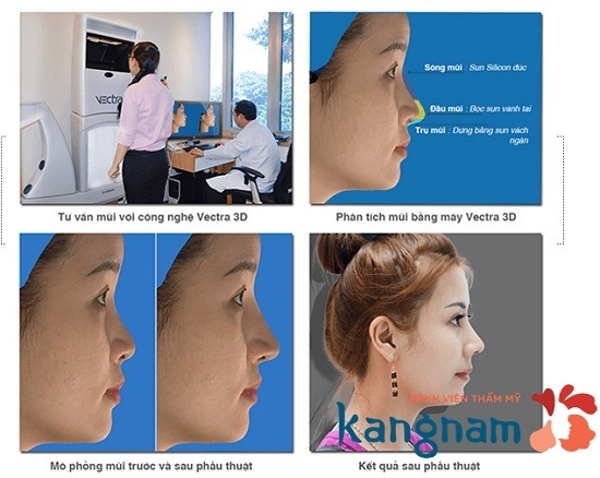 Mô hình giải đáp phẫu thuật nâng mũi ở đâu đẹp tại Hà Nội và TP HCM? Mô hình giải đáp nâng mũi ở đâu đẹp?