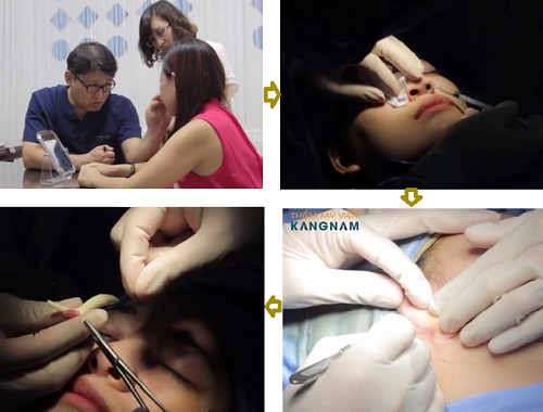 Tuyệt chiêu nâng cao sống mũi để sở hữu sống mũi đẹp hoàn hảo Tuyệt chiêu nâng cao sống mũi để sở hữu sống mũi đẹp hoàn hảo