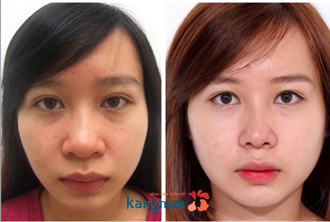 Phẫu thuật thu nhỏ đầu mũi có đau không? trước và sau khi thu nhỏ đầu mũi tại kangnam Phẫu thuật thu nhỏ đầu mũi có đau không? trước và sau khi thu nhỏ đầu mũi tại kangnam