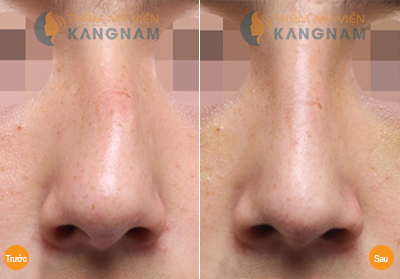 Vẹo vách ngăn mũi có nên phẫu thuật không 1