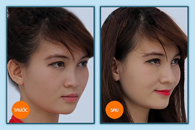 Tất tần tật những điều cần biết về nâng mũi đẹp tự nhiên