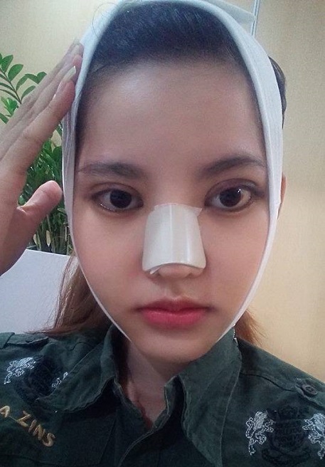 Sau khi sửa mũi bao lâu mới được quan hệ?