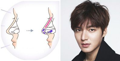 Nâng mũi L-line – Xu hướng làm đẹp mũi mới nhất hiện nay