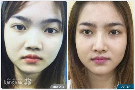 Phẫu thuật nâng mũi bọc sụn ở đâu đẹp tại Hà Nội và TP HCM?