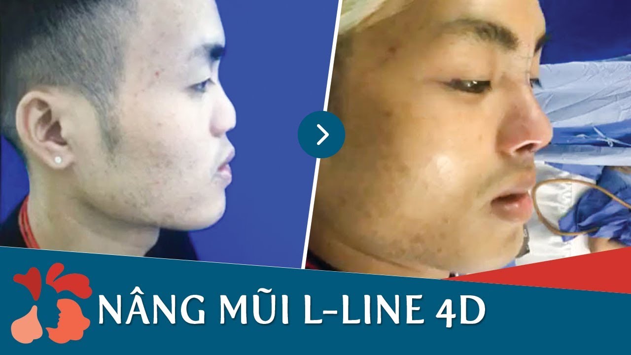 Ca phẫu thuật nâng mũi cho nam giới “SIÊU KHÓ” tại Kangnam