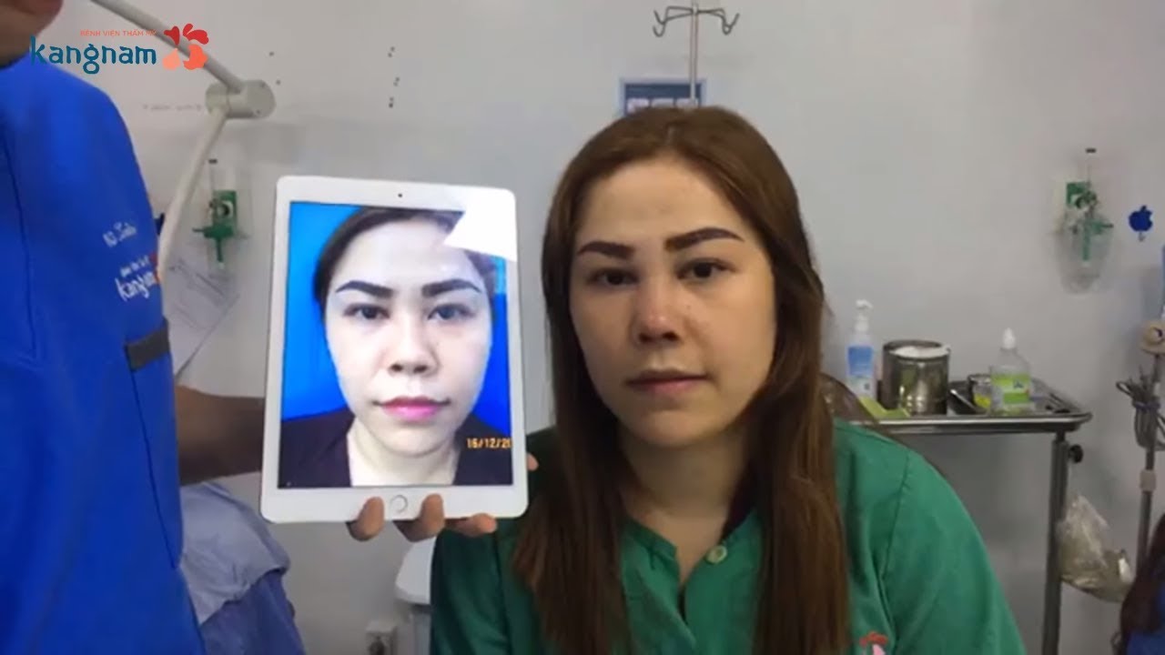 Cận cảnh kết quả nâng mũi của khách hàng được FREE 100%
