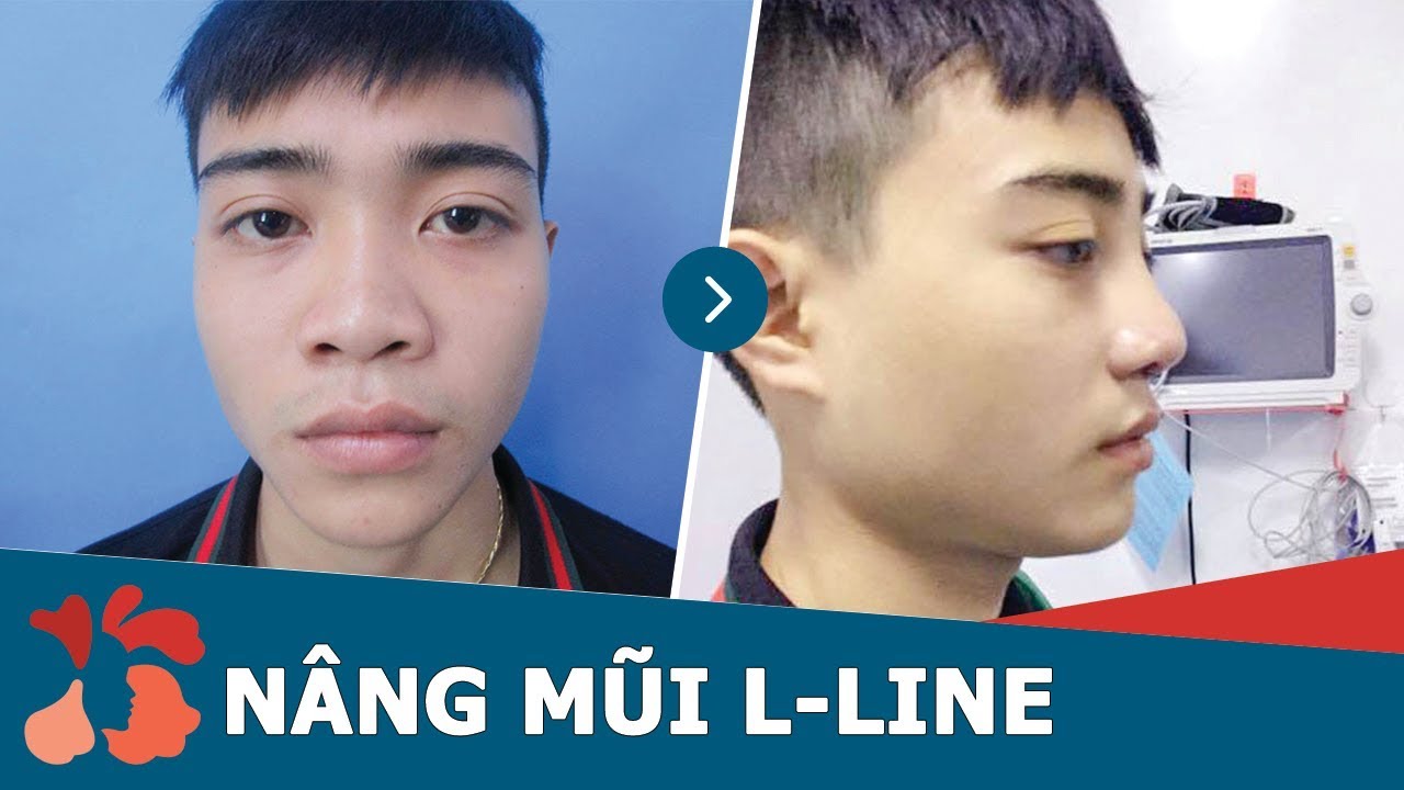 Cận cảnh kết quả nâng mũi L-Line cho nam giới