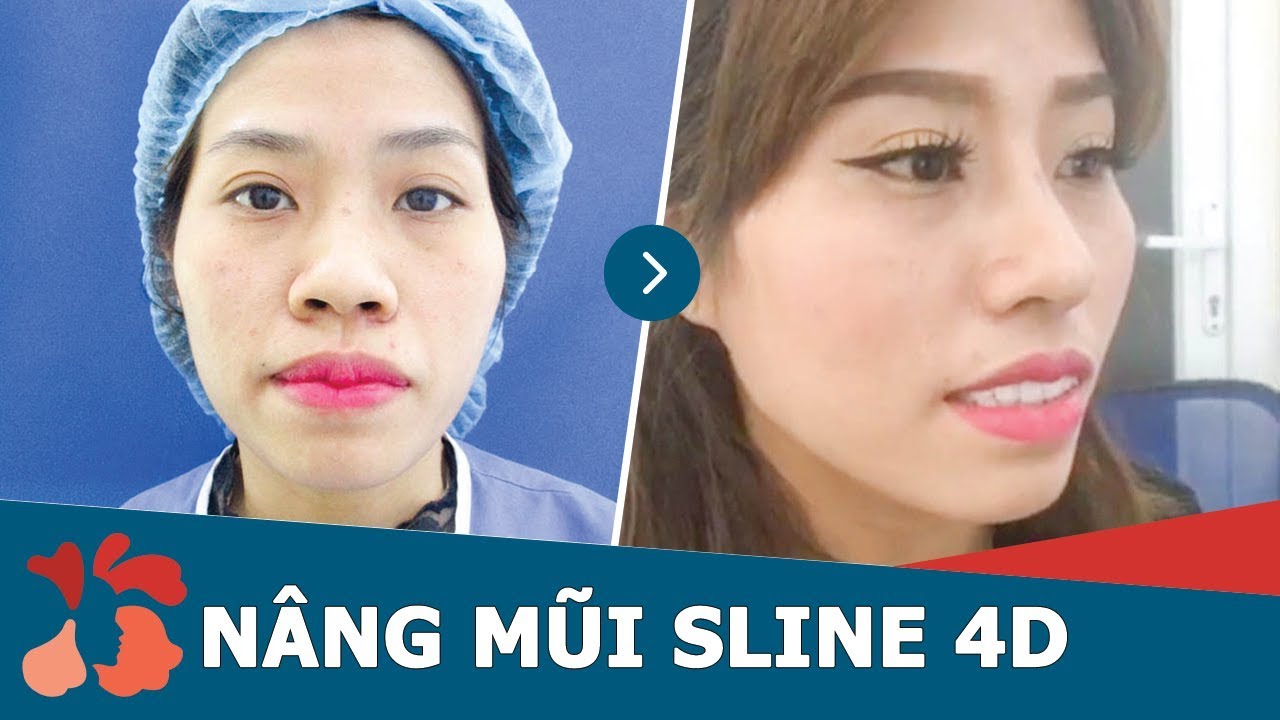 Cô nàng “LỘT XÁC” 180 độ sau khi nâng mũi S Line 4D