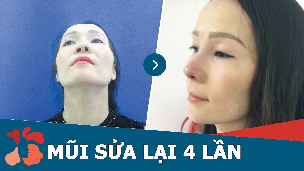 Giải pháp nâng mũi sửa lại sau 4 lần phẫu thuật THẤT BẠI