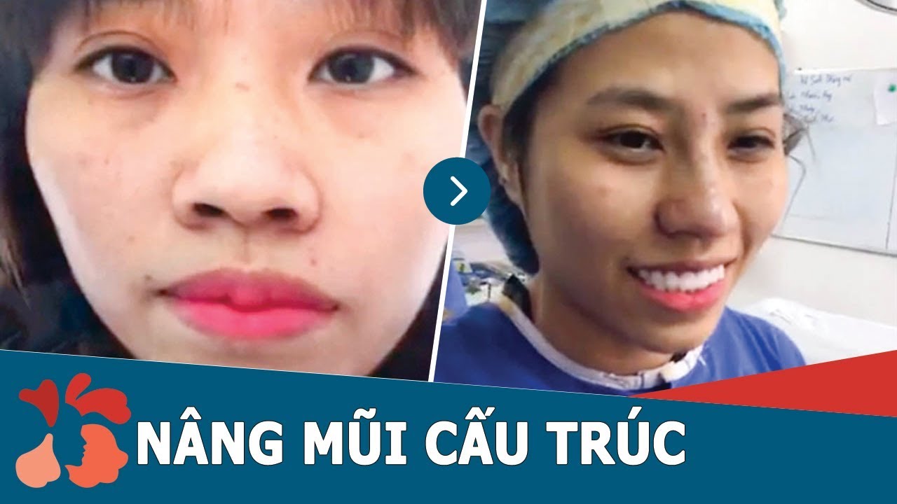 Giới thiệu giải pháp thẩm mỹ mũi HOT nhất hiện nay