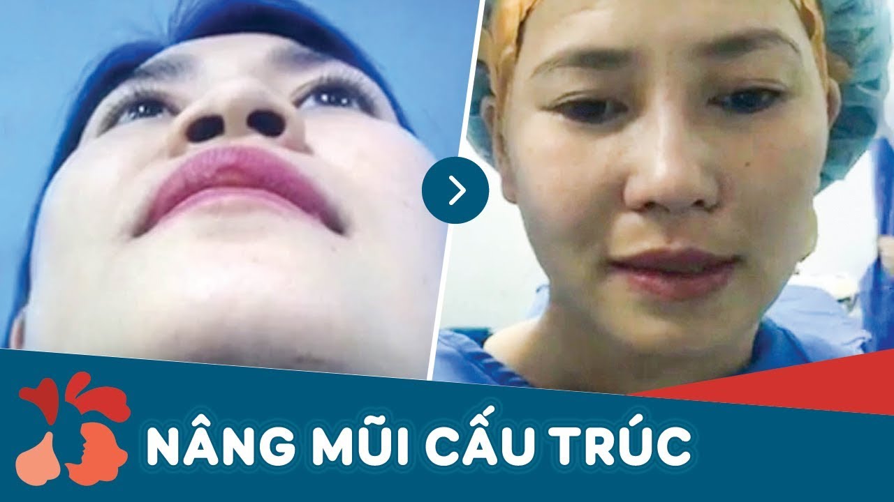 Khắc phục mũi biến dạng do nâng mũi bằng chỉ bị hỏng