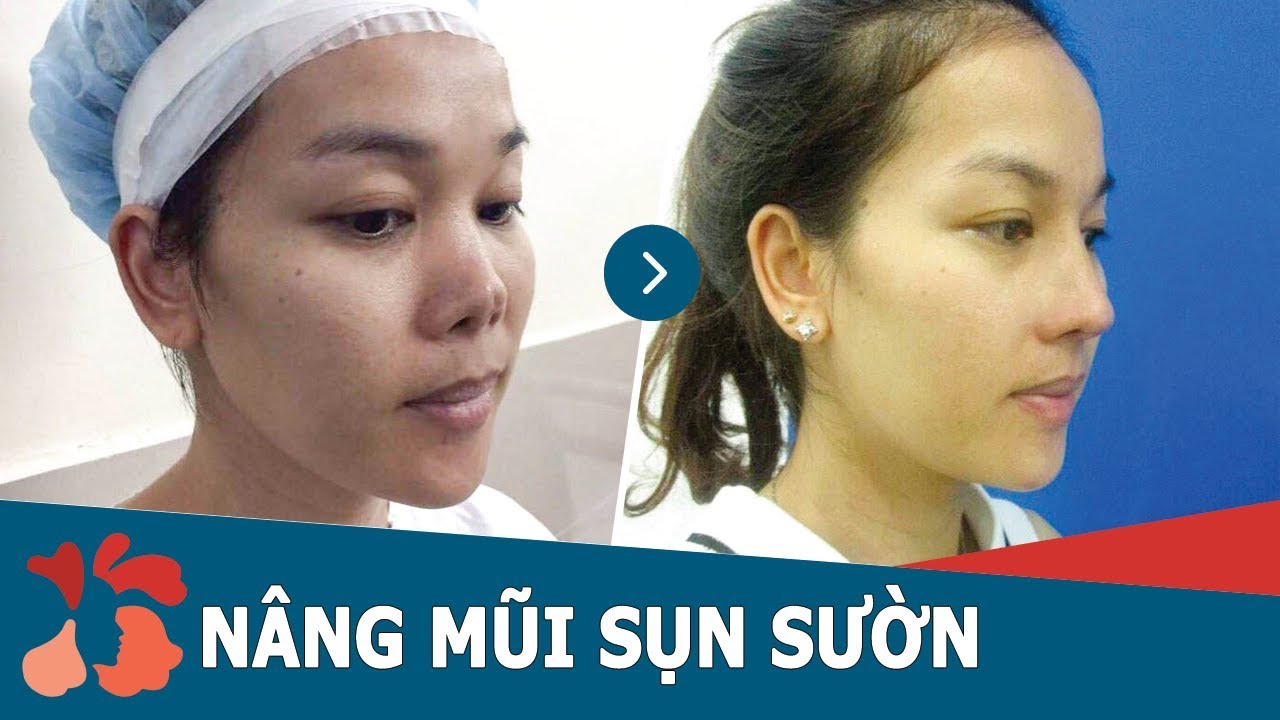 Khắc phục mũi phẫu thuật hỏng nhờ nâng mũi sụn sườn