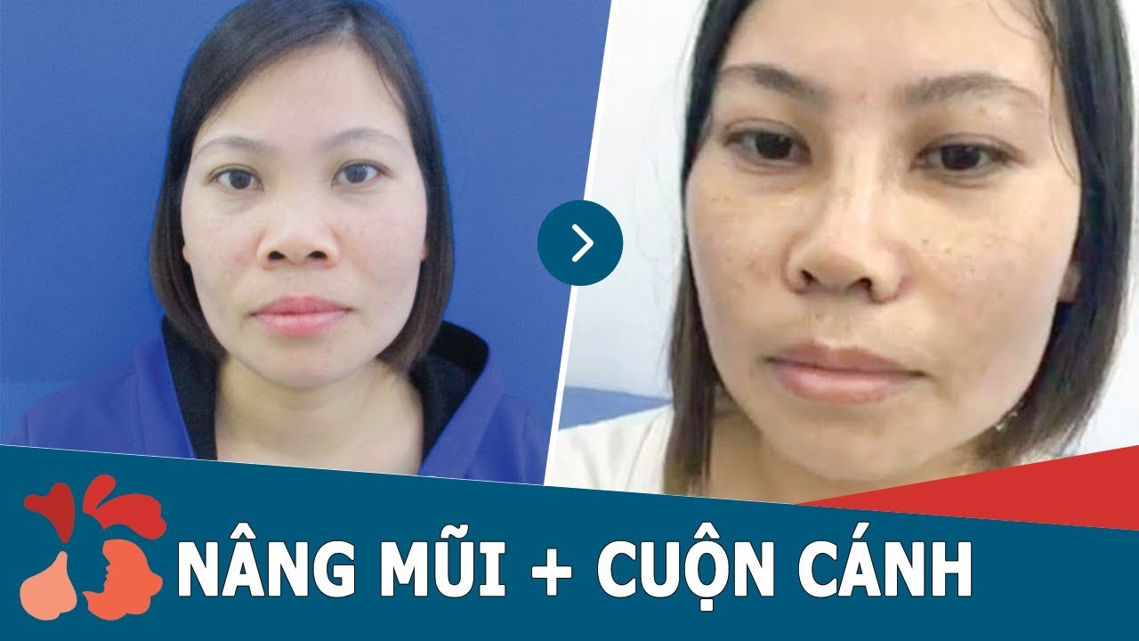 Khách hàng nâng mũi + Cuộn cánh mũi tại Kangnam
