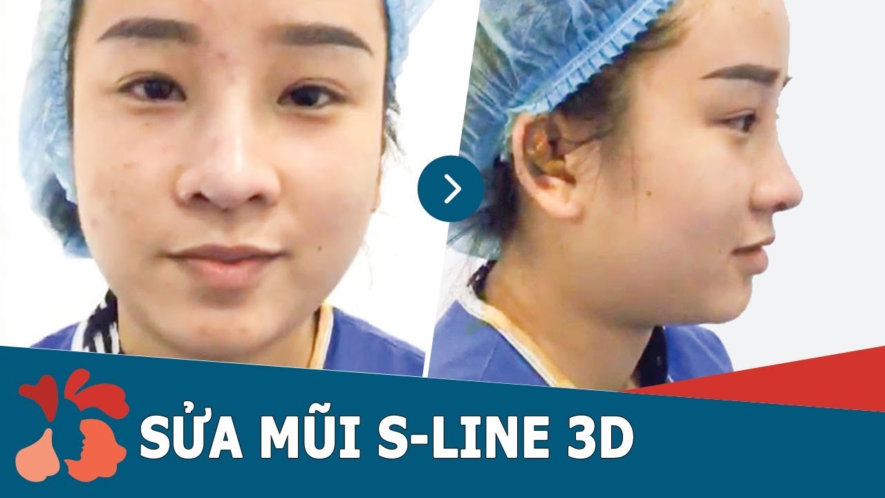 Sửa mũi S-Line – Mũi đẹp chuẩn Á Đông