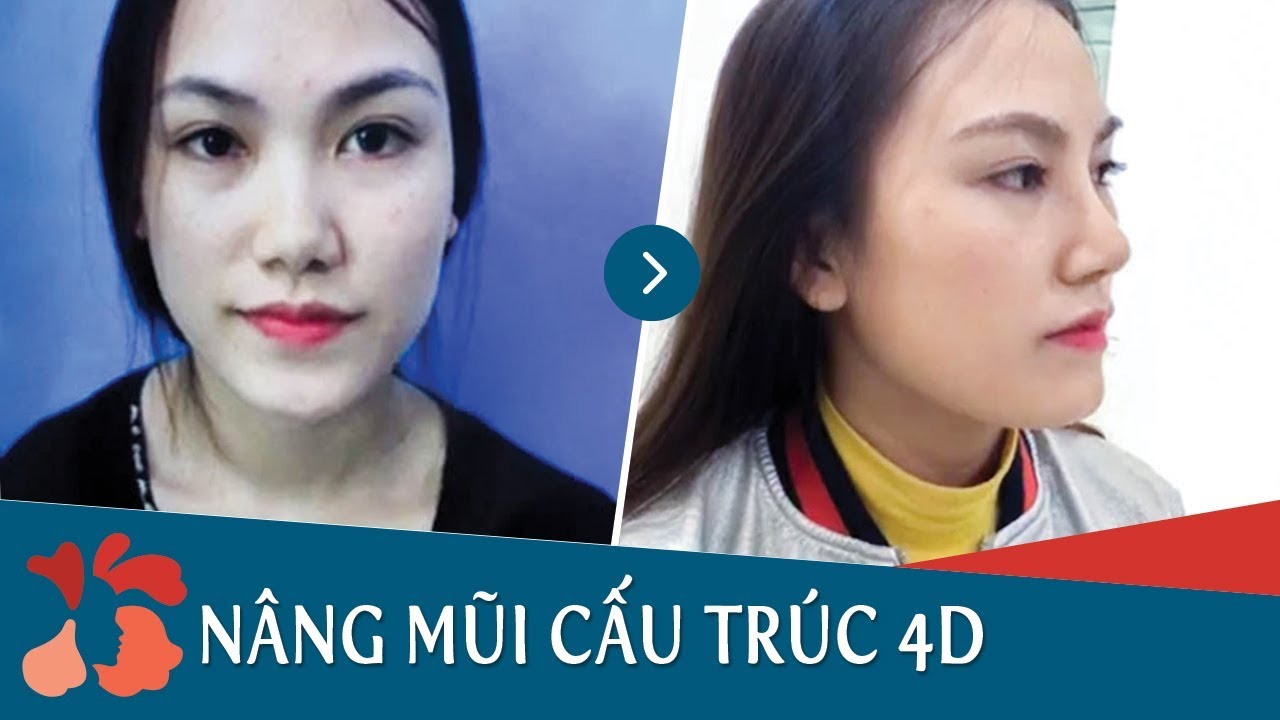 Tái khám nâng mũi cấu trúc 4D sau 1 tháng tại Kangnam