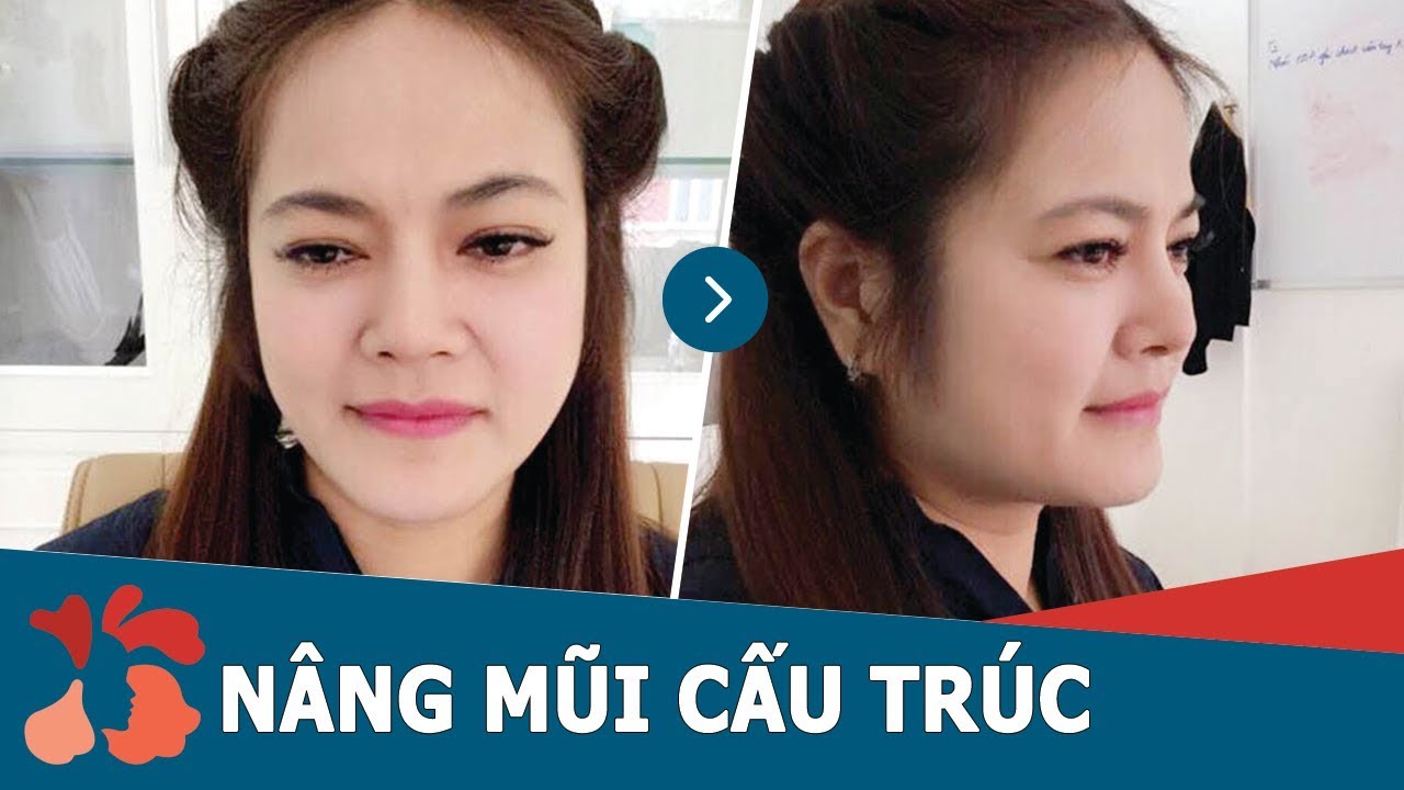 Tái khám sửa mũi phẫu thuật hỏng sau 1 tháng