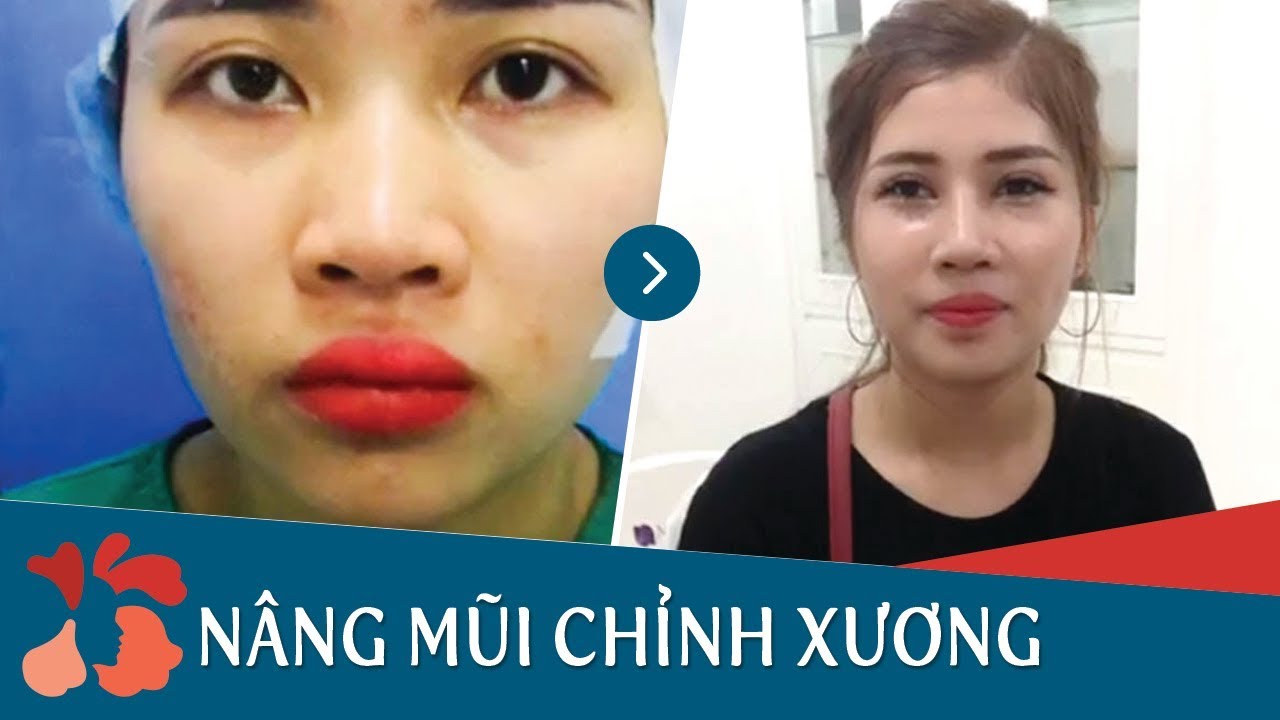 Tận mắt sự thay đổi của khách hàng sau khi nâng mũi