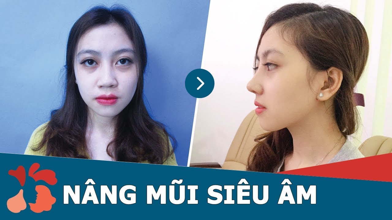 Tìm hiểu công nghệ nâng mũi cấu trúc siêu âm tại Kangnam