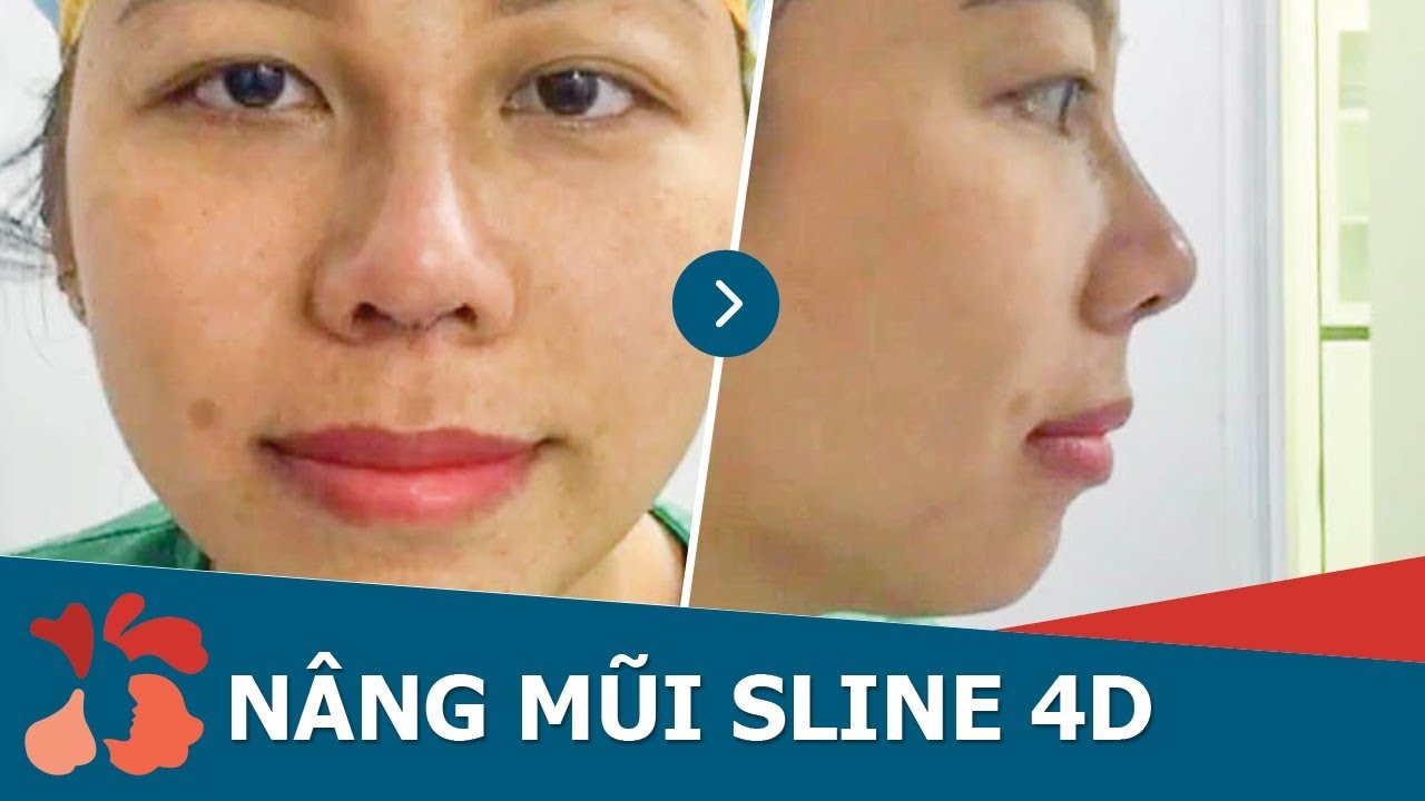 Ca nâng mũi khắc phục được cả khuyết điểm hàm hô