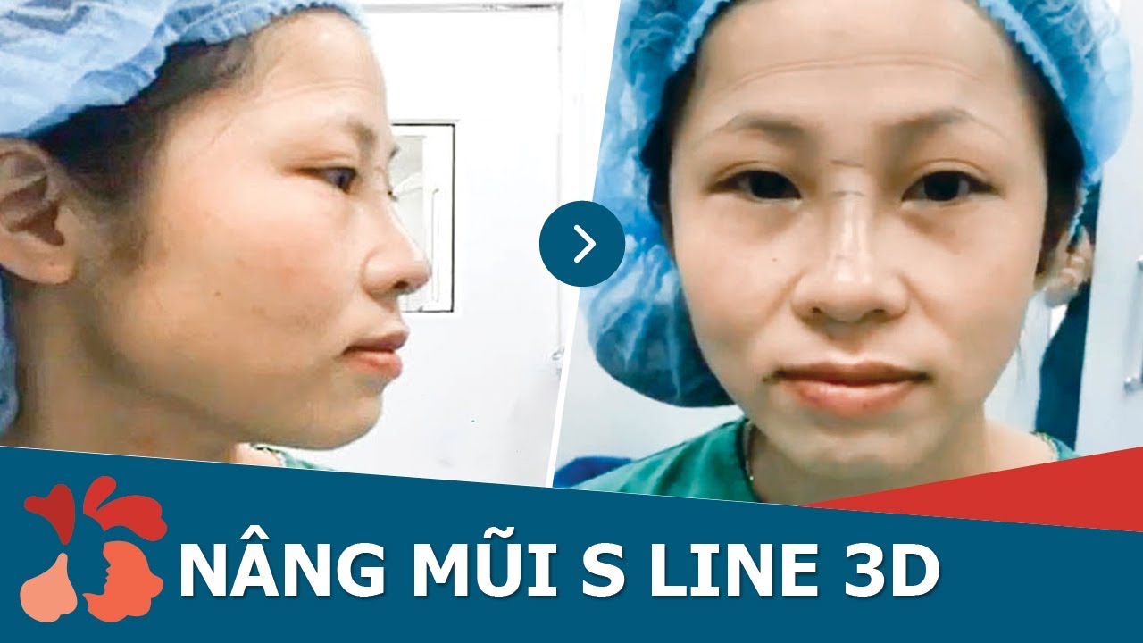Cận cảnh kết quả nâng mũi SLine 3D đẹp không tì vết