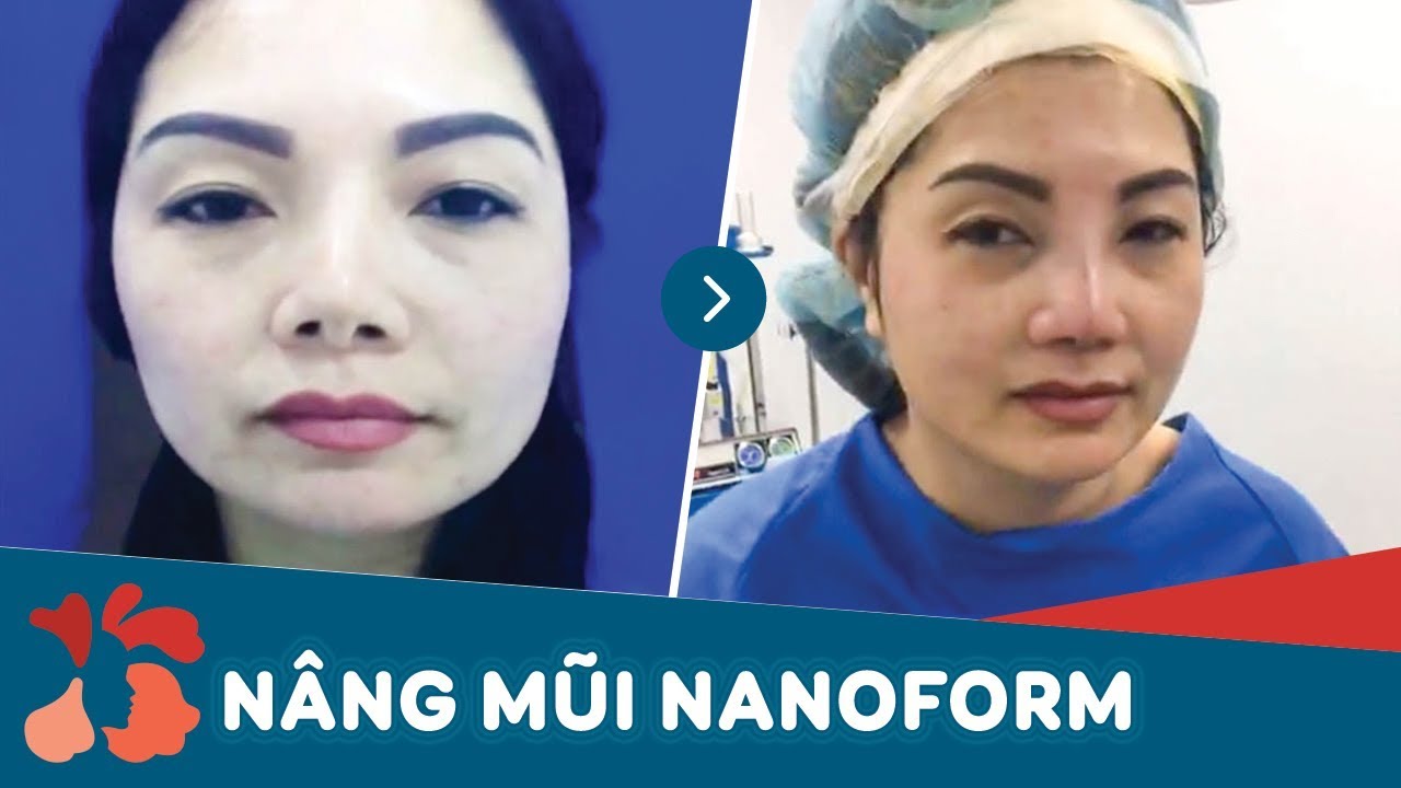 Kết quả nâng mũi NanoForm công nghệ độc quyền tại Kangnam