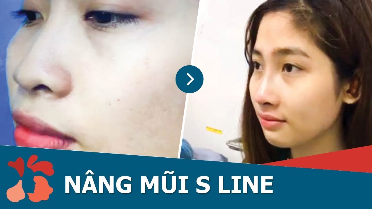 Khách hàng nâng mũi bằng sụn tai tại Kangnam