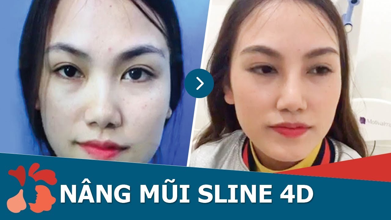 Khách hàng tái khám nâng mũi sau 1 tháng tại Kangnam