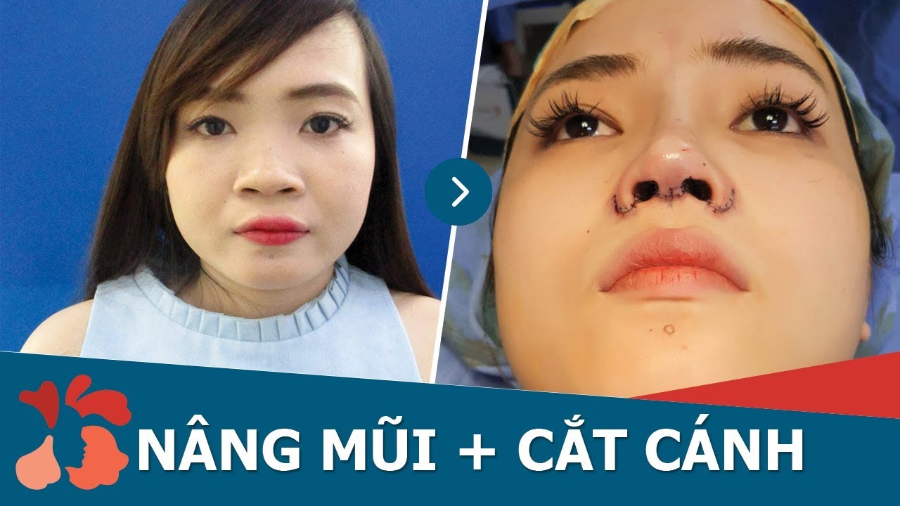 Khách hàng thực hiện Combo nâng mũi + Cuộn cánh